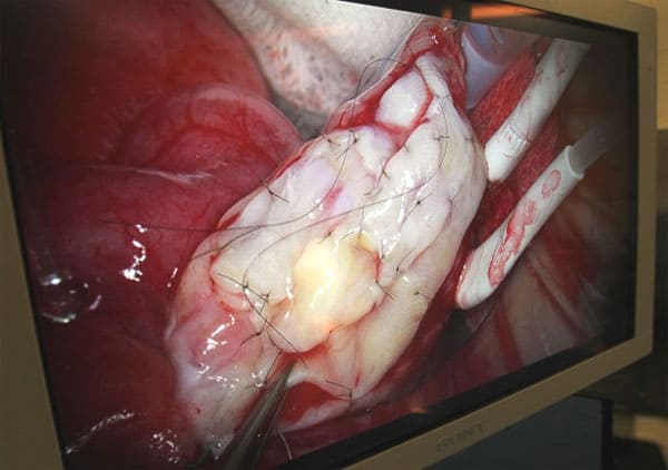 A detail of the the "quilted" strip of frozen ovarian tissue grafted onto the existing ovary of patient Jenny Remington-Hobbs during an operation at St. Luke's Hospital in Chesterfield on Oct. 12, 2012. 