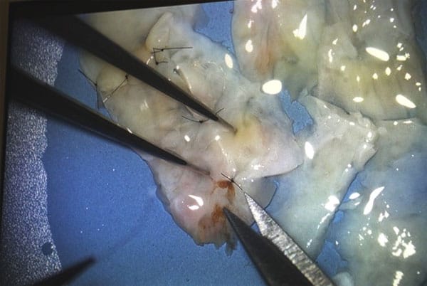 A detail of the the "quilted" strip of frozen ovarian tissue before it was grafted on the remaining ovary of patient Jenny Remington-Hobbs during an operation at St. Luke's Hospital in Chesterfield on Oct. 12, 2012.