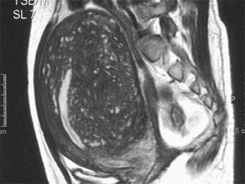 Figure 1 MRI demonstrating huge adenomyomatous uterus with intact endometrial cavity.