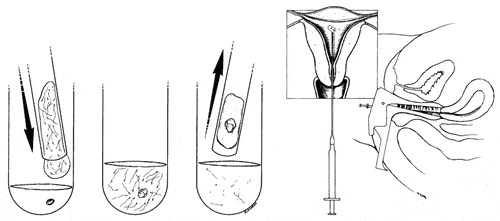 With IVF, your eggs are fertilized with your husband’s sperm in a petri dish or a test tube, and the embryos are replaced back into your uterus two to five days later.