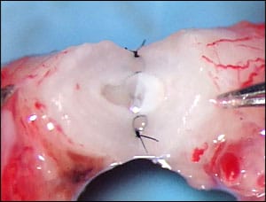 Fig. 15-2 Photo demonstrates the basic strategy of the microscopic two-layer reconnection of the vas deferens.