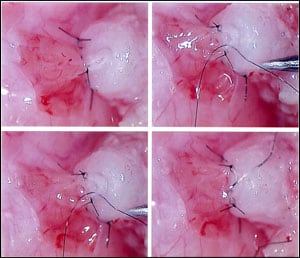 Fig. 15-1 Photo demonstrates microsurgical technique to bypass epididymal damage when reversing vasectomy which is much more delicate than just “reconnecting the vas.”