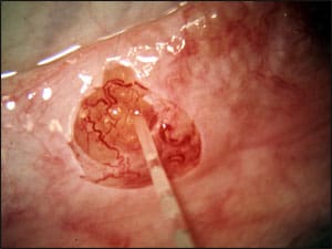 Fig. 15-3 Microsurgically aspirating sperm from the epididymis moving closer and closer to the testicle until there is suddenly a brisk outpouring of huge quantities of sperm under high pressure.