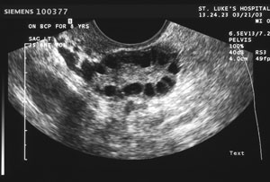 A non-invasive ultrasound technique called “Antral Follicle Count” [see video], as well as an isoteric blood test called ”AMH”, can tell us just where you are on your age related biological clock, and when you should start to worry.