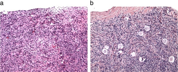 Figure 1: (a) Showing the absence of primordial or preantral follicles in ovarian biopsies of this candidate for ovarian transplantation compared with (b) that in her fertile sister.