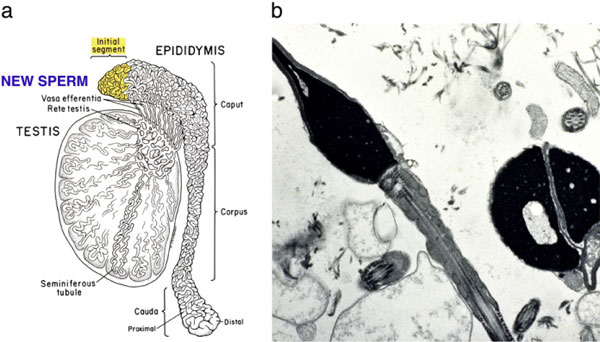 Figure 8: A diagram of the serial transection of the epididymis in a patient who had undergone vasectomy but has no sperm in the vas fluid. At some point proximally in the epididymis, secondary epididymal obstruction is bypassed and then normal motile sperm are seen.