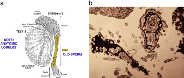 Figure 9: A diagram of the serial transection of the epididymis in a patient who had undergone vasectomy but has no sperm in the vas fluid. At some point proximally in the epididymis, secondary epididymal obstruction is bypassed and then normal motile sperm are seen.