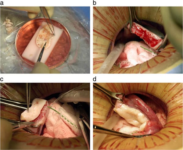 Figure 2: Steps in the procedure of ovarian transplantation between MZ twin sisters: (a) preparation of donor ovarian cortex by dissection in a Petri dish on ice; (b) preparation of recipient ovarian medulla; (c) attaching donor cortical tissue to recipient ovarian medulla; (d) attaching thawed donor cortical tissue for re-transplant to the recipient medulla.