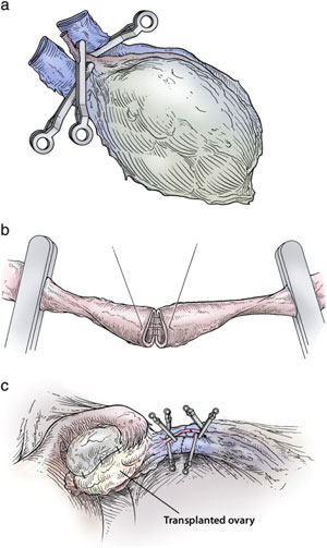 Figure 3: Steps in the procedure of intact ovary microvascular transplantation: (a) microsurgical isolation of donor ovary blood supply; (b) end-to-end anastomosis of ovarian blood vessel; (c) completed anastomosis of ovarian artery and veins.