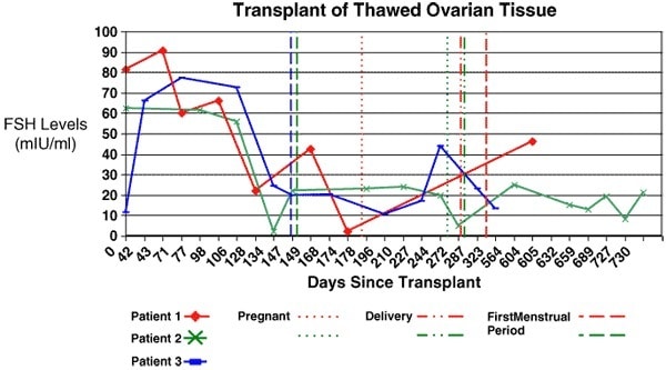 Figure 5: Transplant of thawed ovarian tissue. After a frozen cortical re-transplant, serum FSH declined again to normal levels, similar to those of fresh transplants. 