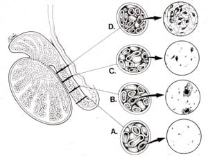 Epididymal blowouts must be repaired or bypassed microsurgically in order to have high success with vasectomy reversal. 