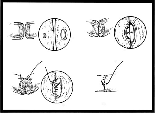 Figure 1. Illustration of two-layer vasovasostomy. Note the importance of matching up the diameters of the lumens with interrupted 9-0 nylon sutures. This would be very difficult to perform accurately with continuous suturing.