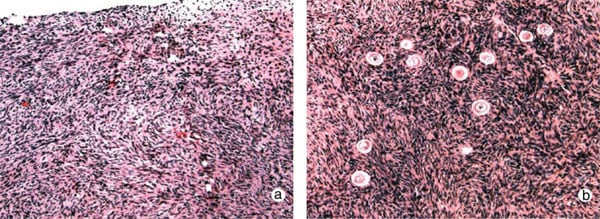 Figure 1: Case R2 showing (a) the absence of primordial or preantral follicles in ovarian biopsies of this candidate for ovarian transplantation compared with (b) that in her fertile sister.