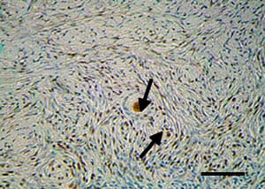 Figure 10. Histological section of vitrified human ovarian tissue. Immunohistochemical staining for proliferating cell nuclear antigen (PCNA), a marker protein for proliferating cells. Abundant PCNA-positive proliferating cells were demonstrated in the interstitial tissue cells and a few proliferating cells were noted in granulose cells (arrows) of vitrified human ovarian tissue. Scale bar represents 50 μm.