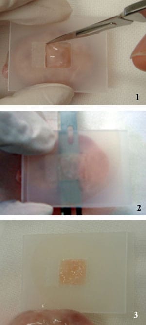 Figure 1: Vitrification procedure: the Cryotissue method. The ovarian tissue slicer was developed, with a plate to produce 1 × 10 × 10 mm slices. (1) The tissue slicer was put on the surface of ovary. (2) Then another plate was put on the tissue slicer, the ovary was cut between the slicer and the surface of ovary by using a sharp edge. (3) The ovarian tissue was cut into 1 × 10 × 10 mm slices.