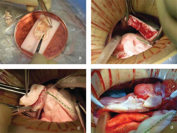 Figure 2: Steps in the procedure of ovarian transplantation between MZ twin sisters: (a) preparation of donor ovarian cortex by dissection in a Petri dish on ice, (b) preparation of recipient ovarian medulla, (c) attaching donor cortical tissue to recipient ovarian medulla, (d) attaching thawed donor cortical tissue for re-transplant to recipient R1.