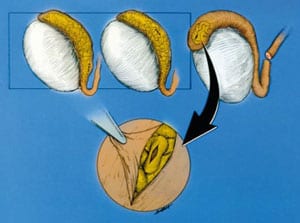 Diagrams of preparing epididymal tubule for end-to-side vasoepididymostomy.