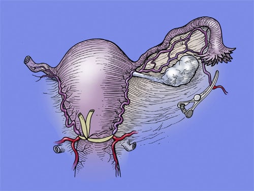 Figure 2 Rubber tubing is placed widely around the proximal cervix, thus encompassing the uterine vessels and acting as a tourniquet. 