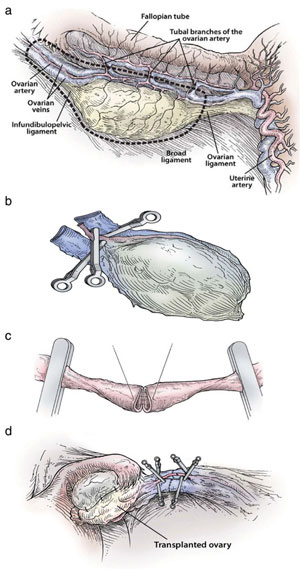 Figure 3: Steps in the procedure of intact ovary microvascular trans- plantation: (a) depiction of donor oophorectomy, (b) microsurgical isolation of donor ovary blood supply, (c) end-to-end anastomosis of ovarian blood vessel, (d) completed anastomosis of ovarian artery and veins.