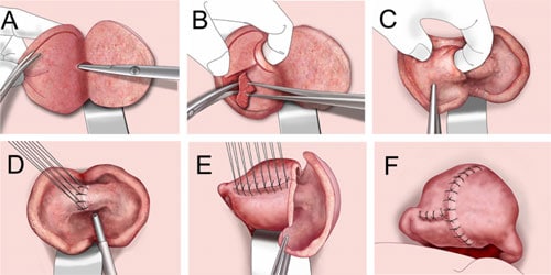 Figure 3 (A–F) Diagrammatic depiction of the stages of the triple-flap method.