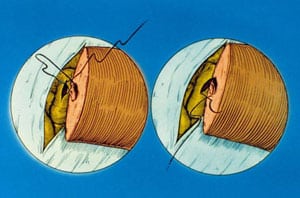 Diagram showing first 3 posterior mucosal sutures for end-to-side vasoepididymostomy.