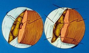 Diagram showing completed mucosal anastomosis end-to-side vasoepididymostomy.