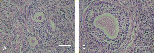 Figure 9. Morphologically normal oocyte in a pre-antral follicle from vitrified-warmed human ovarian tissue. (A) Normal oocyte was surrounded by one or two layers of somatic cells in normal interstitial tissue of vitrified ovarian tissue. Haematoxylin–eosin staining. (B) Normal oocyte was surrounded by three or four layers of somatic cells in normal interstitial tissue of vitrified ovarian tissue. Scale bar represents 50 μm.