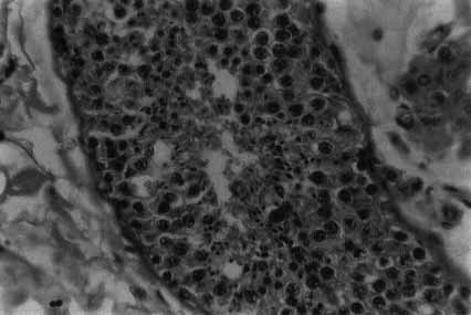 Figure 5 Testicle biopsy showing normal spermatogenesis. The dark small oval-shaped cells toward the center of the tubule are sperm heads. The larger cells with clearly discernible chromatin strands are the pachytene spermatocytes