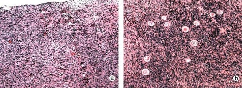 Figure 1: Case R2 showing (a) the absence of primordial or preantral follicles in ovarian biopsies of this candidate for ovarian transplantation compared with (b) that in her fertile sister.