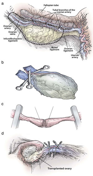 Figure 3: Steps in the procedure of intact ovary microvascular transplantation: (a) depiction of donor oophorectomy, (b) microsurgical isolation of donor ovary blood supply, (c) end-to-end anastomosis of ovarian blood vessel, (d) completed anastomosis of ovarian artery and veins