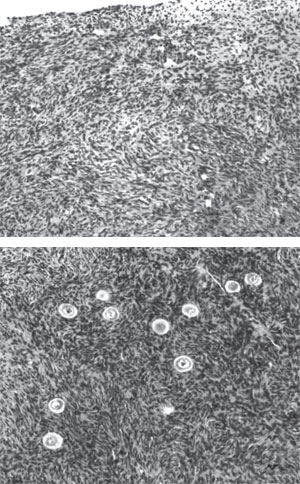 Figures 42.1A and B: (A) Showing the absence of primordial or preantral follicles in ovarian biopsies of this candidate for ovarian transplantation compared with (B) that in her fertile sister