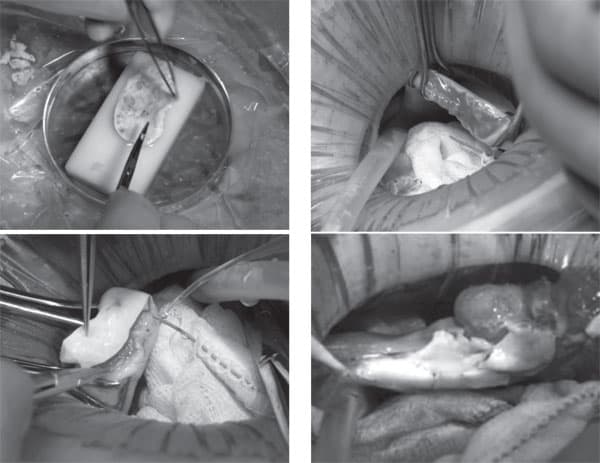 Figures 42.2A to D: Steps in the procedure of ovarian transplantation between MZ twin sisters: (A) preparation of donor ovarian cortex by dissection in a Petri dish on ice; (B) Preparation of recipient ovarian medulla; (C) Attaching donor cortical tissue to recipient ovarian medulla; (D) Attaching thawed donor cortical tissue for re-transplant to the recipient. 