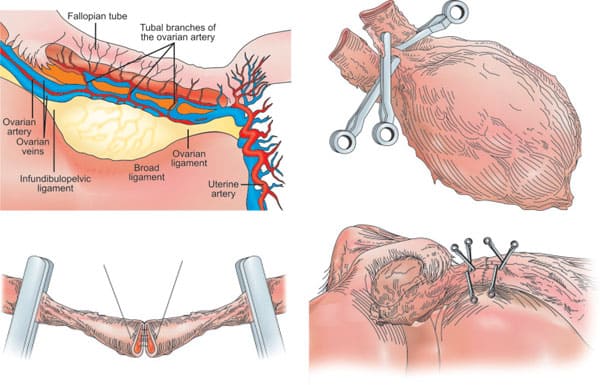 Figures 42.3A to D: Steps in the procedure of intact ovary microvascular transplantation: (A) Depiction of donor oophorectomy; (B) Microsurgical isolation of donor ovary blood supply; (C) End-to-end anastomosis of ovarian blood vessel; (D) Completed anastomosis of ovarian artery and veins.