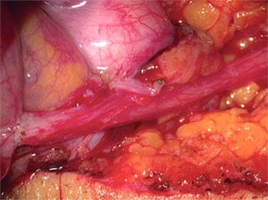 Perfect microsurgery to correct obstruction even for a huge area of missing vas. 