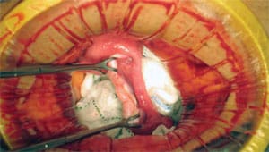 Healthy ovarian tissue is implanted in the recipient completing the ovary tissue transplant.