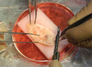 Ovarian Tissue Transplant Surgery