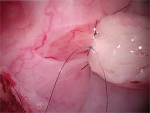 Perfect microsurgery to bypass epididymal obstruction.