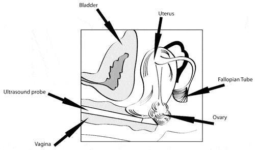 FIGURE 7: Side view of ultrasound probe in vagina during routine pelvic exam.