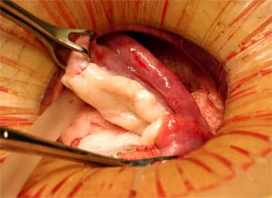 Transplantation of frozen ovarian tissue.