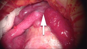 Tubal-ligation (picture 1)