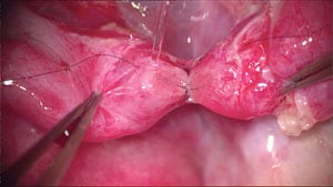 Second mucosal microscopic suture placed but not tied.