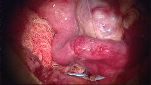 First microscopic suture being placed in isthmus.