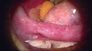 Completed anastomosis, ampulla to isthmus with Fallopian tube draped over ovary.