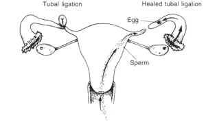 Fig. 15-6 Tubal ligation and healed tubal ligation.