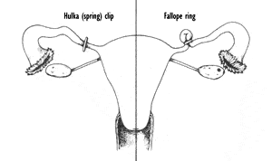 Fig. 15-7 Hulka (spring) clip and Fallope ring.