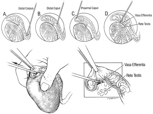 Figure 3 A depiction of microsurgical epididymal sperm aspiration (MESA) beginning at the distal corpus (a) and moving proximally to the distal caput, the proximal caput, and the vasa efferentia (b, c and d). With obstructive azoospermia, there is an inversion of the usual physiological location of greatest and least sperm motility. With obstruction, the most motile sperm are always the most proximal. Distal sperm, because of senescence, are the least motile (Silber et al., 1990a).