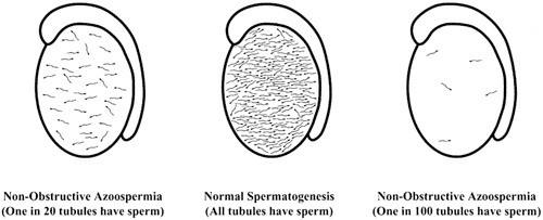 Figure 5 Various 'degrees' of azoospermia. Normal spermatogenesis (centre drawing) is associated with obstructive azoospermia. With non-obstructive azoospermia, TESE may be easy as in the drawing depicted on the left, or very difficult as depicted in the drawing on the right. 