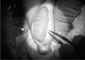 Figure 7 A single large testicular incision for a TESE procedure under the operating microscope results in minimal to no testicular damage, minimal to no post-operative pain, and an ability to analyse each specific seminiferous tubule for the presence of spermatogenesis. (Silber, 2000b).