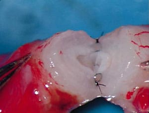 Figure 1. Picture of 2-layer microsurgical vasovasostomy. 