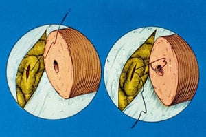 Diagram showing placement of first mucosa suture for end-to-side vasoepididymostomy.